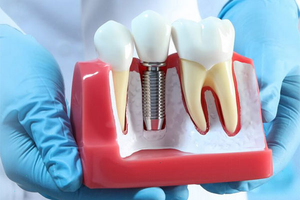 dental implant 01