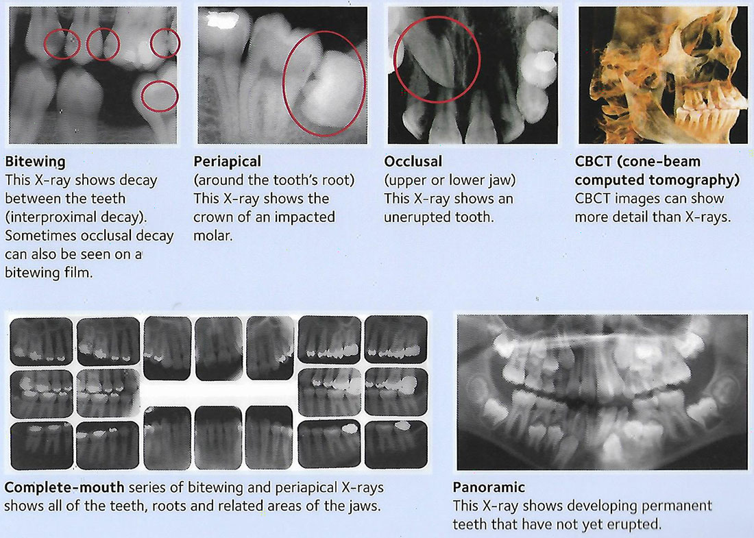 Dental XRay