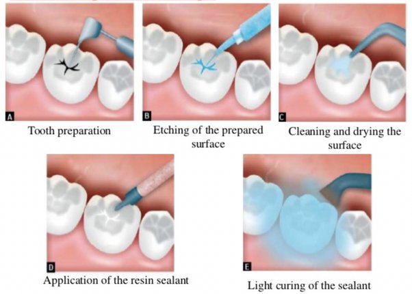 Sealants