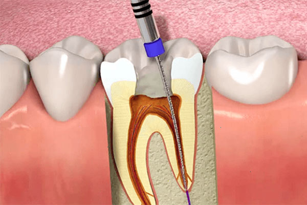 Root Canal