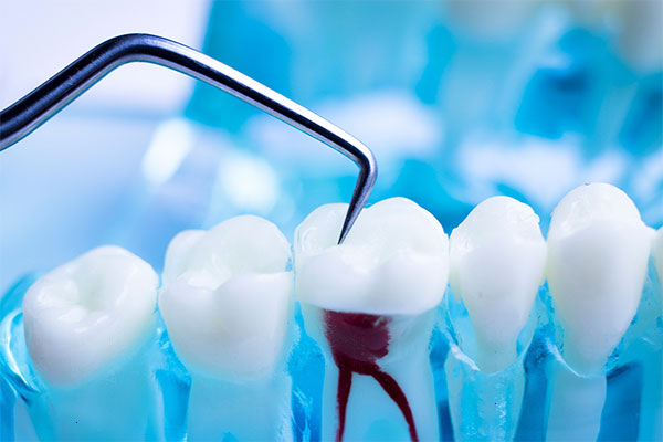 Root Canal Treatment