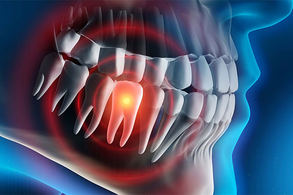 Tooth Extractions