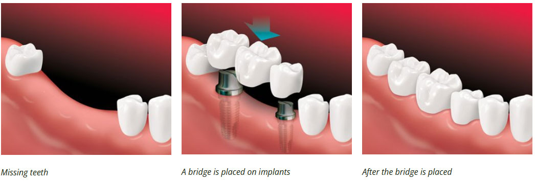 implant supported bridge