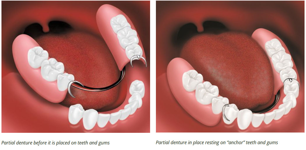 partial denture